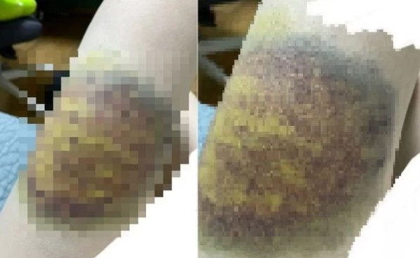 온라인 커뮤니티 사이트 A씨가올린 피멍이 든 부위 사진